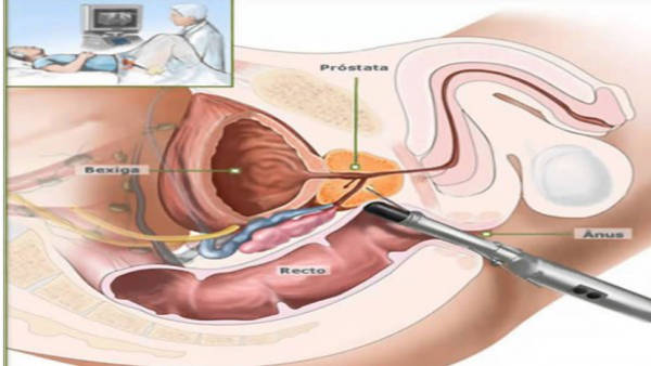Biopsii de fuziune | Cancer de prostată | SANADOR