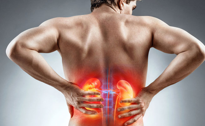 Mitos e verdades sobre cálculo renal